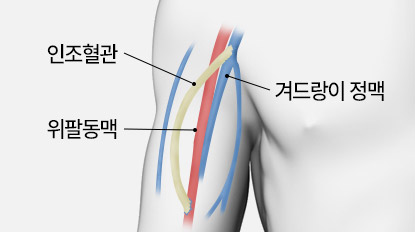 풍선확장술 투석혈관