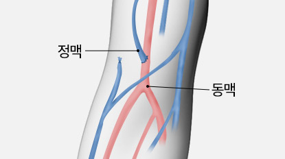 풍선확장술 투석혈관