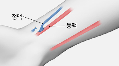 풍선확장술 투석혈관