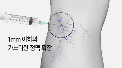 하지정맥류 수술 하지정맥류