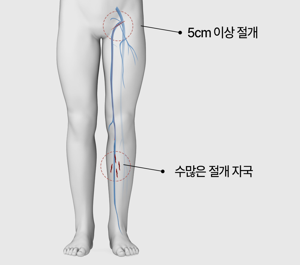 하지정맥류 수술 하지정맥류