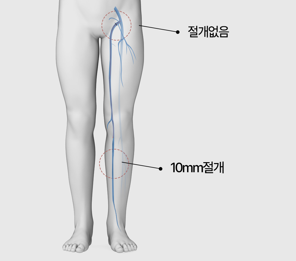 하지정맥류 수술 하지정맥류