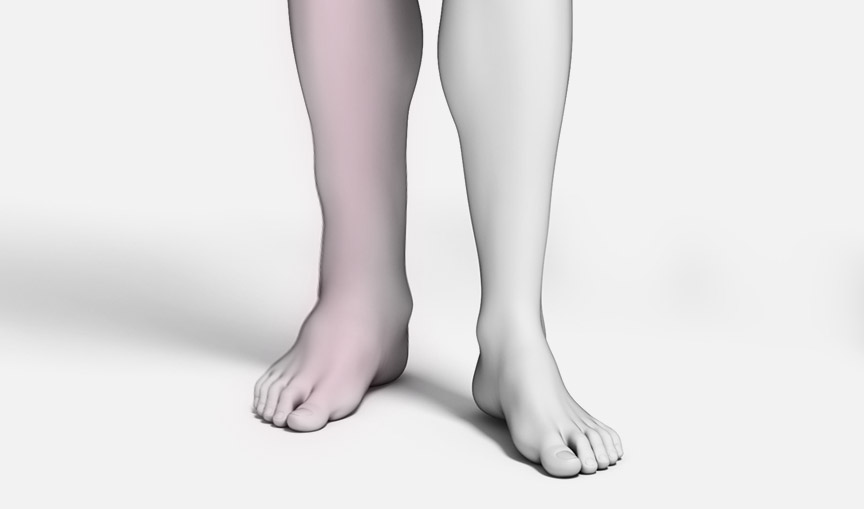 하지정맥류 수술 하지정맥류