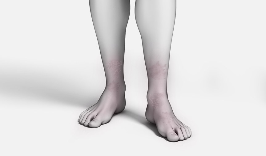 하지정맥류 수술 하지정맥류